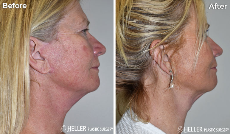 CO2 Face and Neck Lift