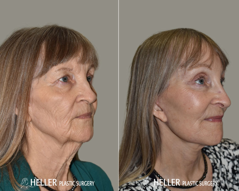 Facelift Before and After