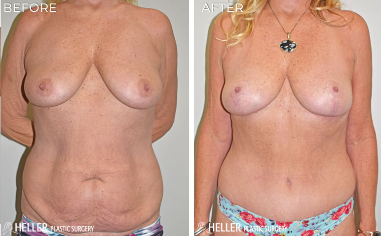 Liposuction to Flanks Before and After