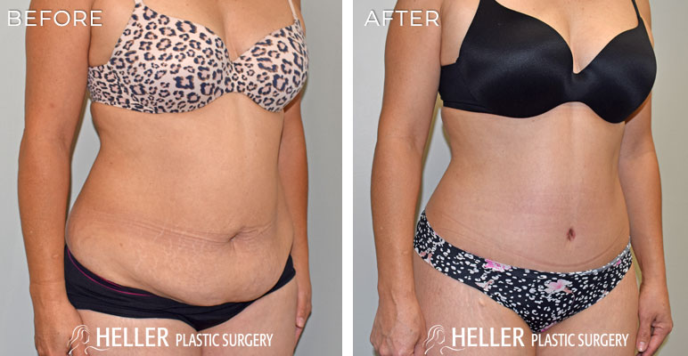 Liposuction to Flanks Before and After