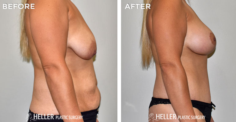 Breast Augmentation with Mastopexy Lift