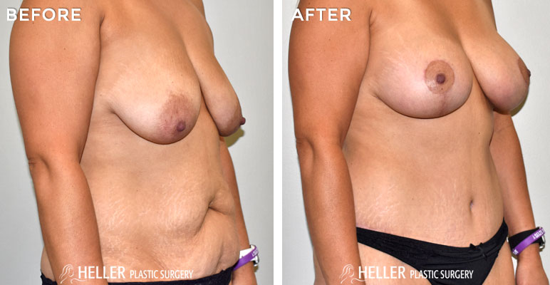 Breast Augmentation with Mastopexy Lift