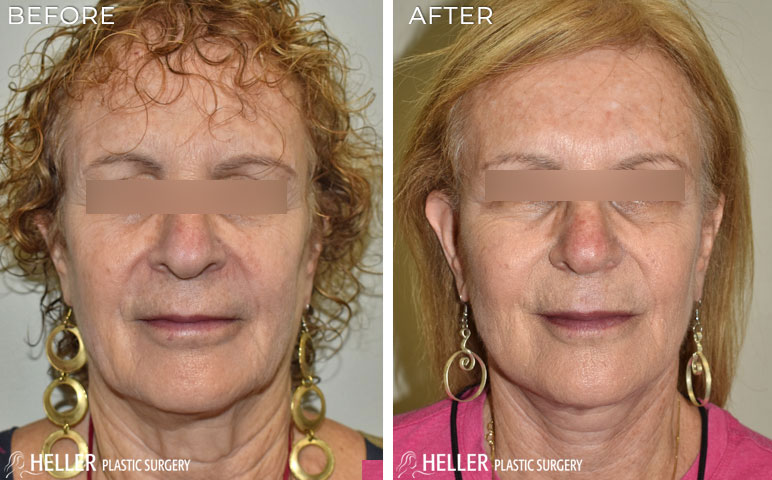 Facelift with fat grafting and temporal brow lift