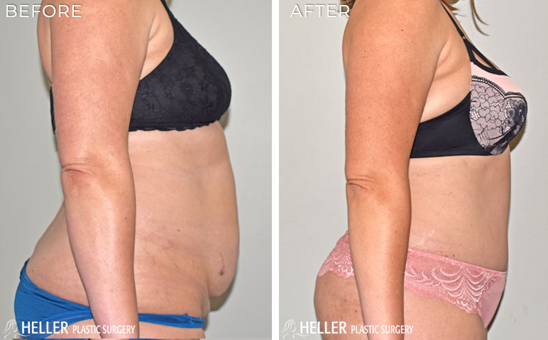 Tummy Tuck with Liposuction Before and After