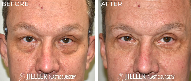 Blepharoplasty Before and after