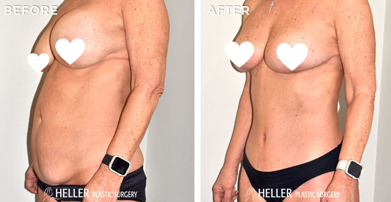 Mommy Makeover and Tummy Tuck Before and after
