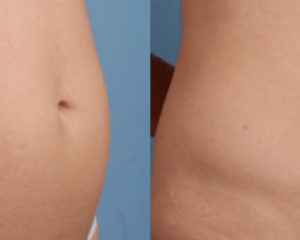 Tummy Surgery - Before and After 6